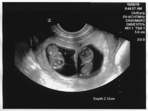 9 Weeks Pregnant Ultrasound Image